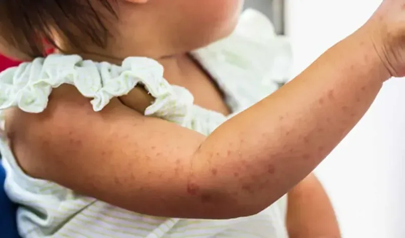Tình hình dịch bệnh tại TP Hồ Chí Minh: Sởi, tay chân miệng và sốt xuất huyết tăng cao